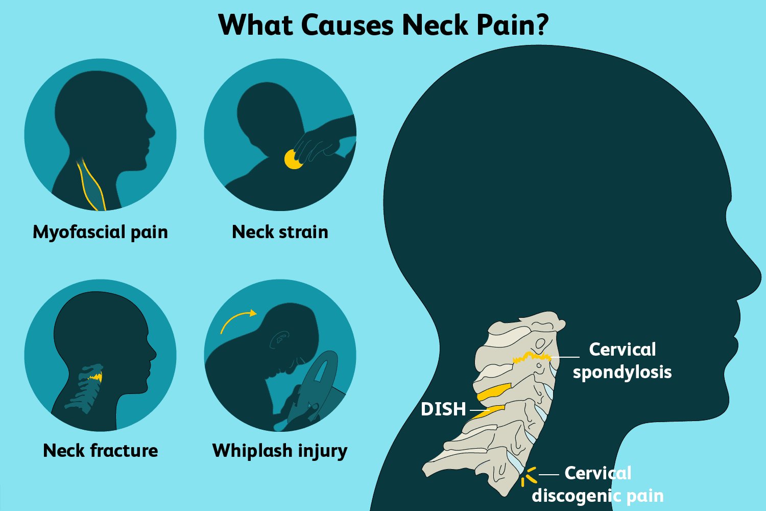 Causes of neck pain including neck strain, myofascial pain, whiplash injury and cervical spondylosis