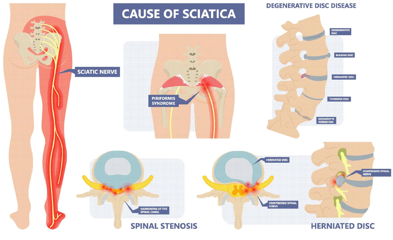 Causes of sciatica: herniated disc, spinal stenosis, degenerative disc disease and piriformis syndrome compressing the sciatic nerve