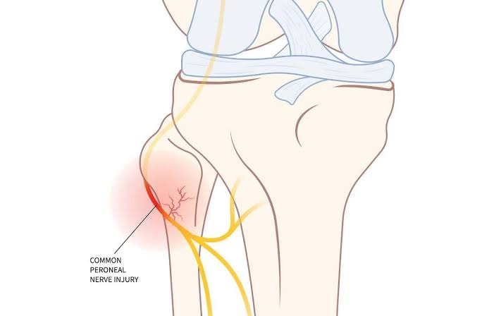Common peroneal nerve injury where the nerve wraps around the outside of the knee
