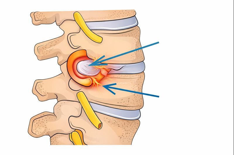 Herniated disc pressing on a spinal nerve, a cause of sciatica