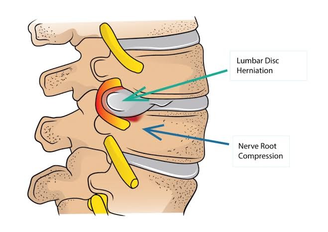 Lumbar disc herniation pressing on a nerve root, a common cause of sciatica
