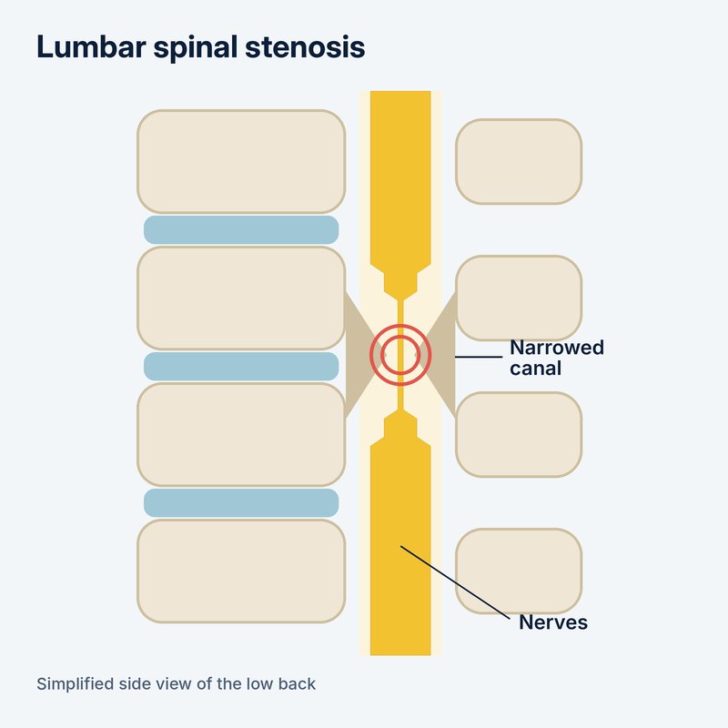 Diagram of lumbar spinal stenosis, where a narrowed spinal canal squeezes the nerves in the low back