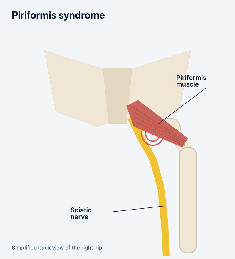 Diagram of piriformis syndrome, with the piriformis muscle crossing the sciatic nerve in the buttock