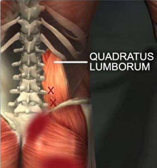 Quadratus lumborum muscle in the low back, a common source of muscle strain and spasm