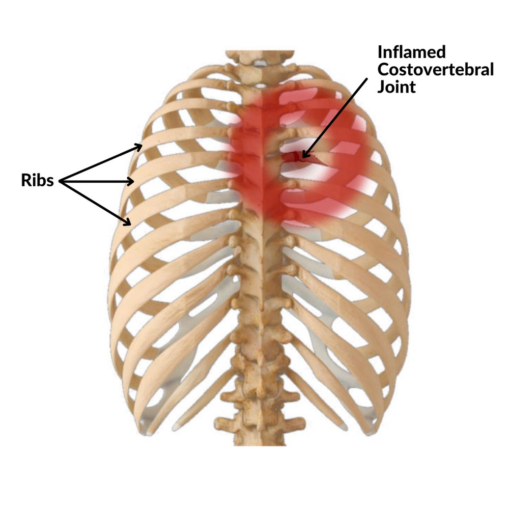 Rib cage from behind showing pain at an inflamed costovertebral joint next to the spine