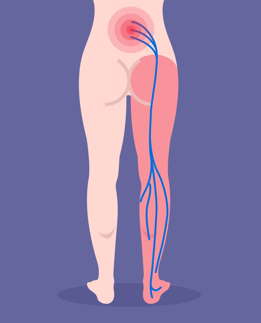 Illustration of sciatica, with nerve pain travelling from the low back through the buttock and down the leg