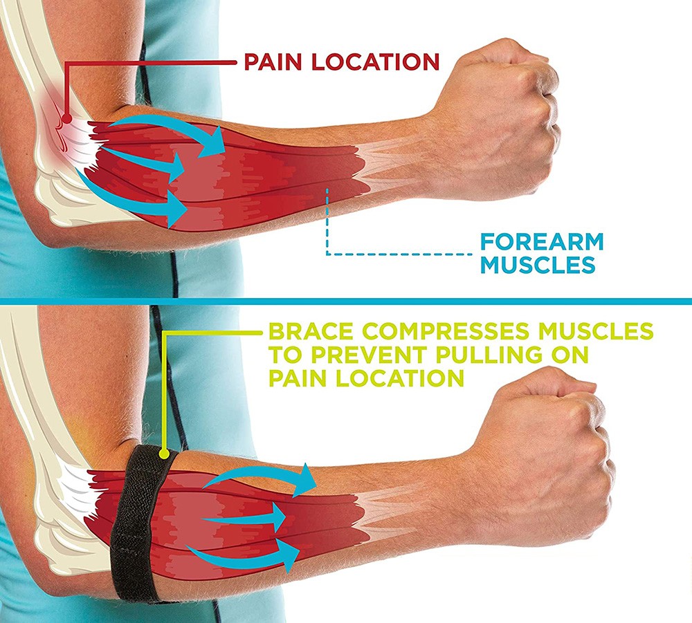 How a tennis elbow brace compresses the forearm muscles to take strain off the painful tendon